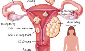 Những điều cần biết về bệnh u xơ tử cung ở phụ nữ