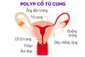 Nguyên nhân gây polyp cổ tử cung