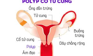 Nguyên nhân gây polyp cổ tử cung